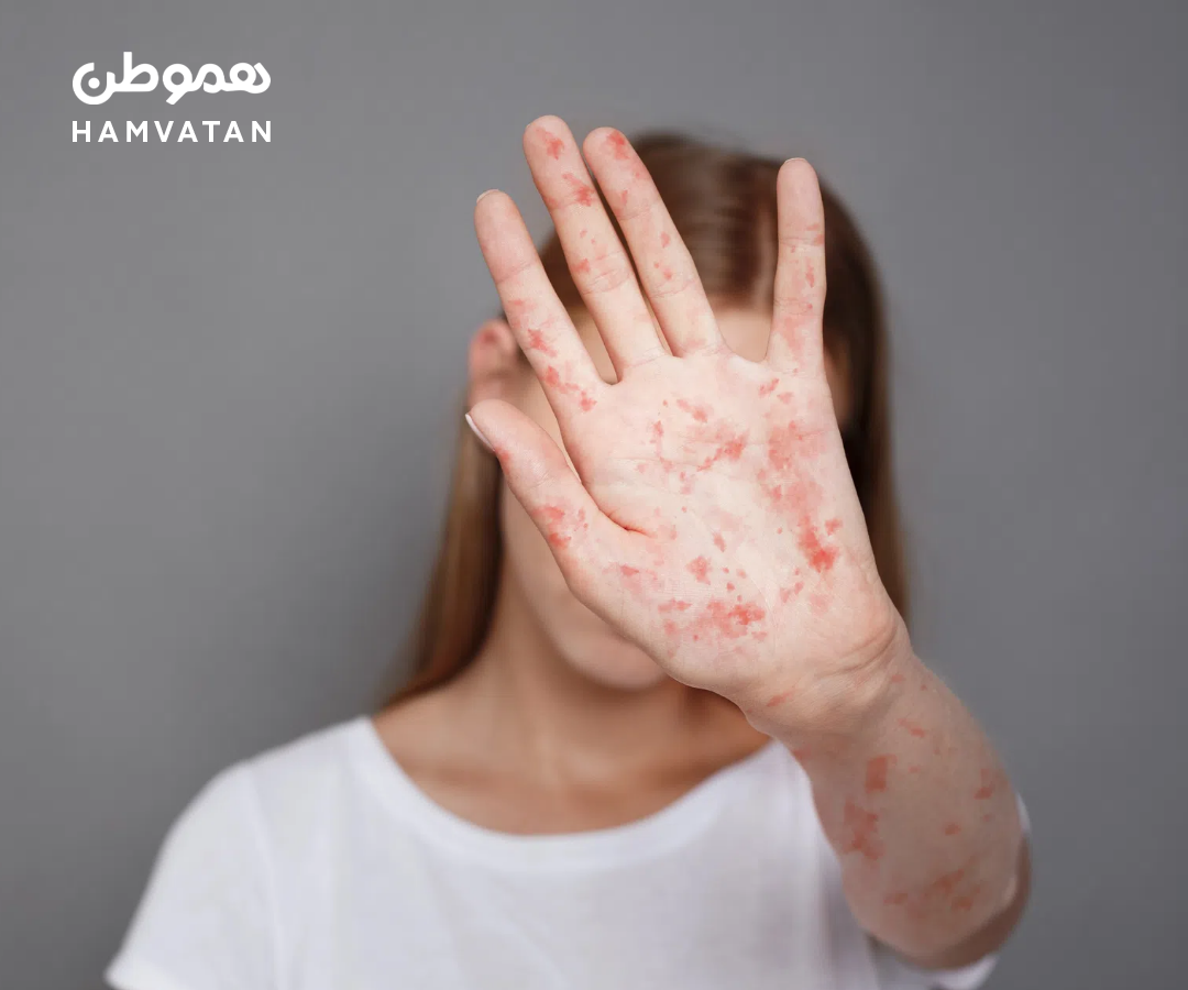 شیوع سرخک در آنتاریو: ۱۰۲ مورد ابتلای جدید در یک هفته