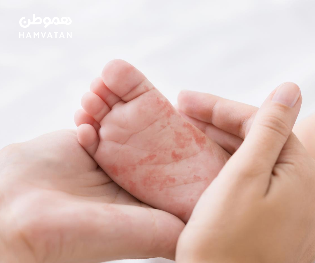 کانادا دیگر جزو کشورهایی نیست که سرخک در آن‌ها ریشه‌کن شده